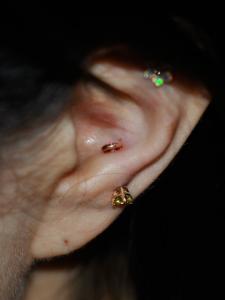 アンチトラガス アンチトラガス