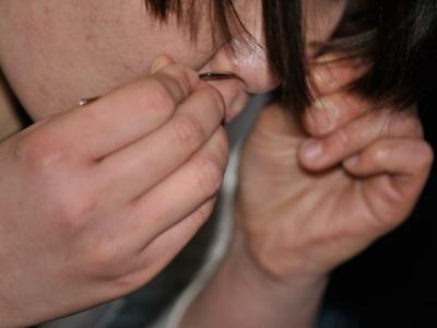 セプタム拡張 セプタム拡張